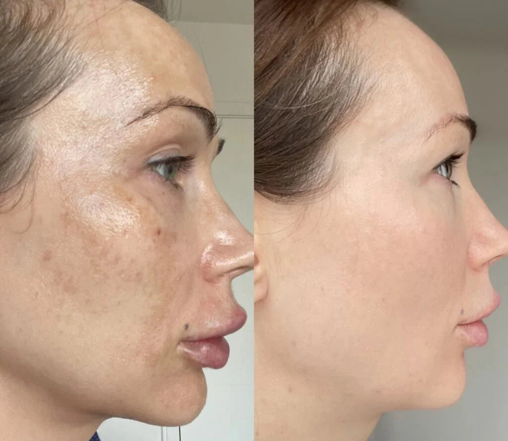 JIYU Toner Pads - Korean Toner Pads Review - Before & After
